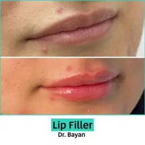 Dermal Fillers Dubai, Russian Lip Fillers Dubai, Lip Augmentation Dubai