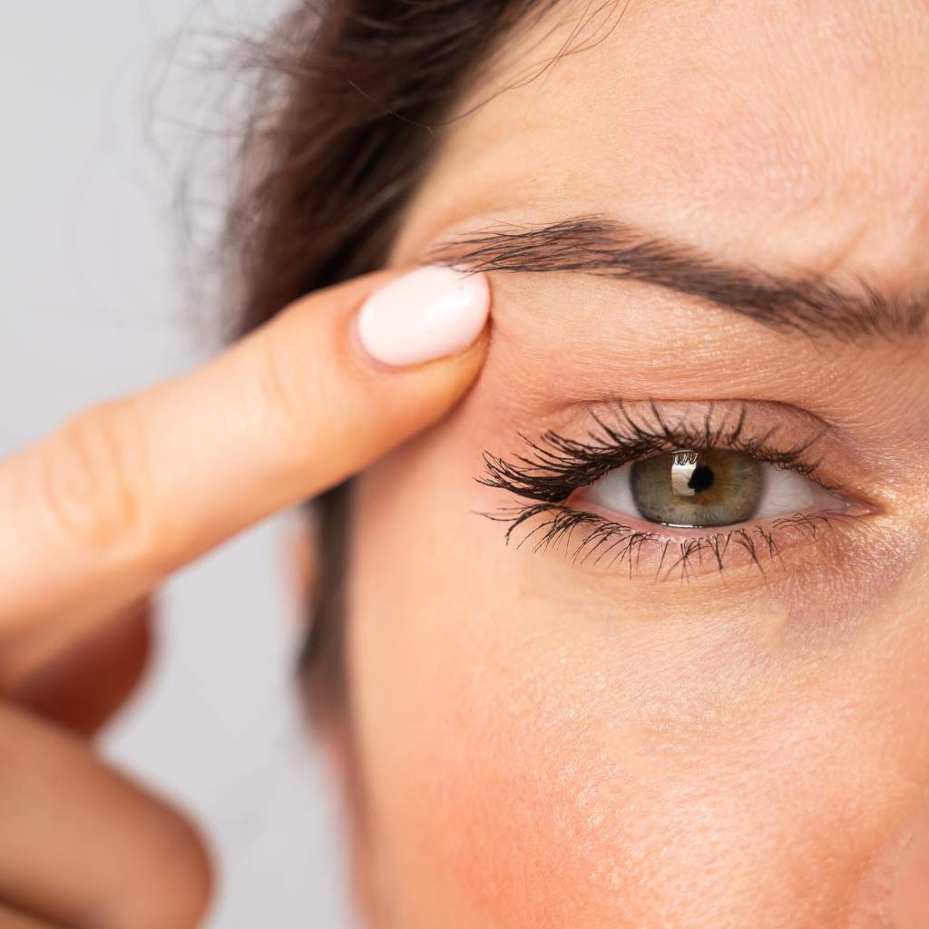 wrinkles around the lower eyelids.