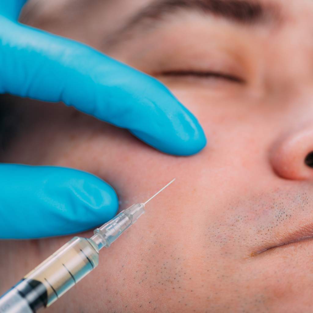 Dermal fillers for nasolabial folds