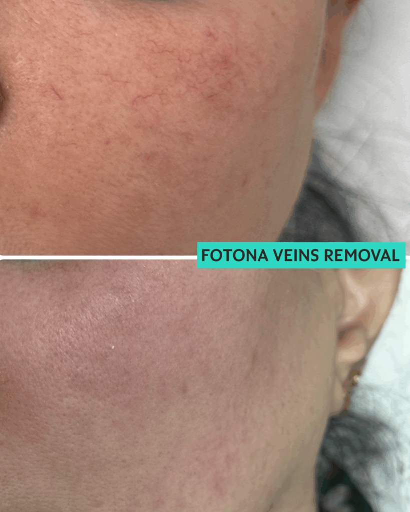 Fotona veins removal