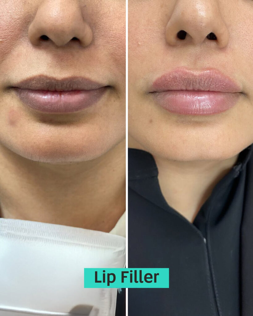 best lip fillers in dubai