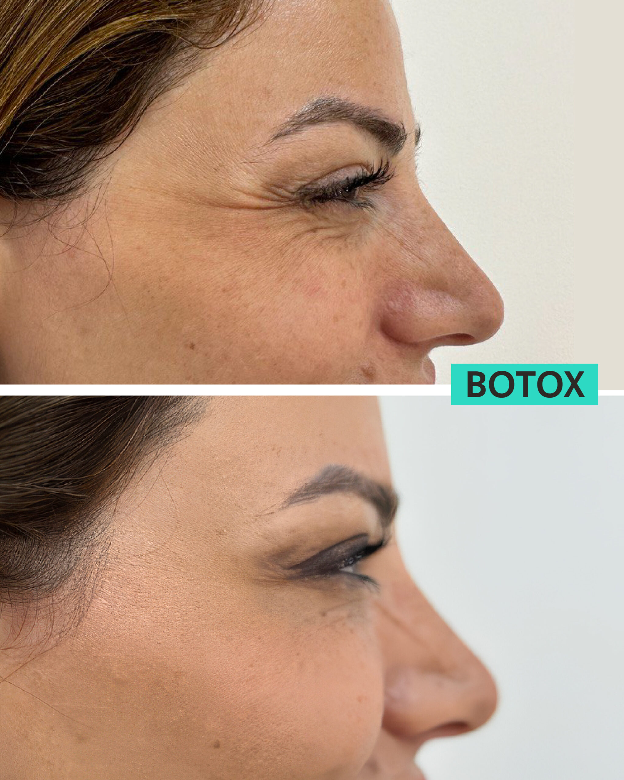 Botox Dubai