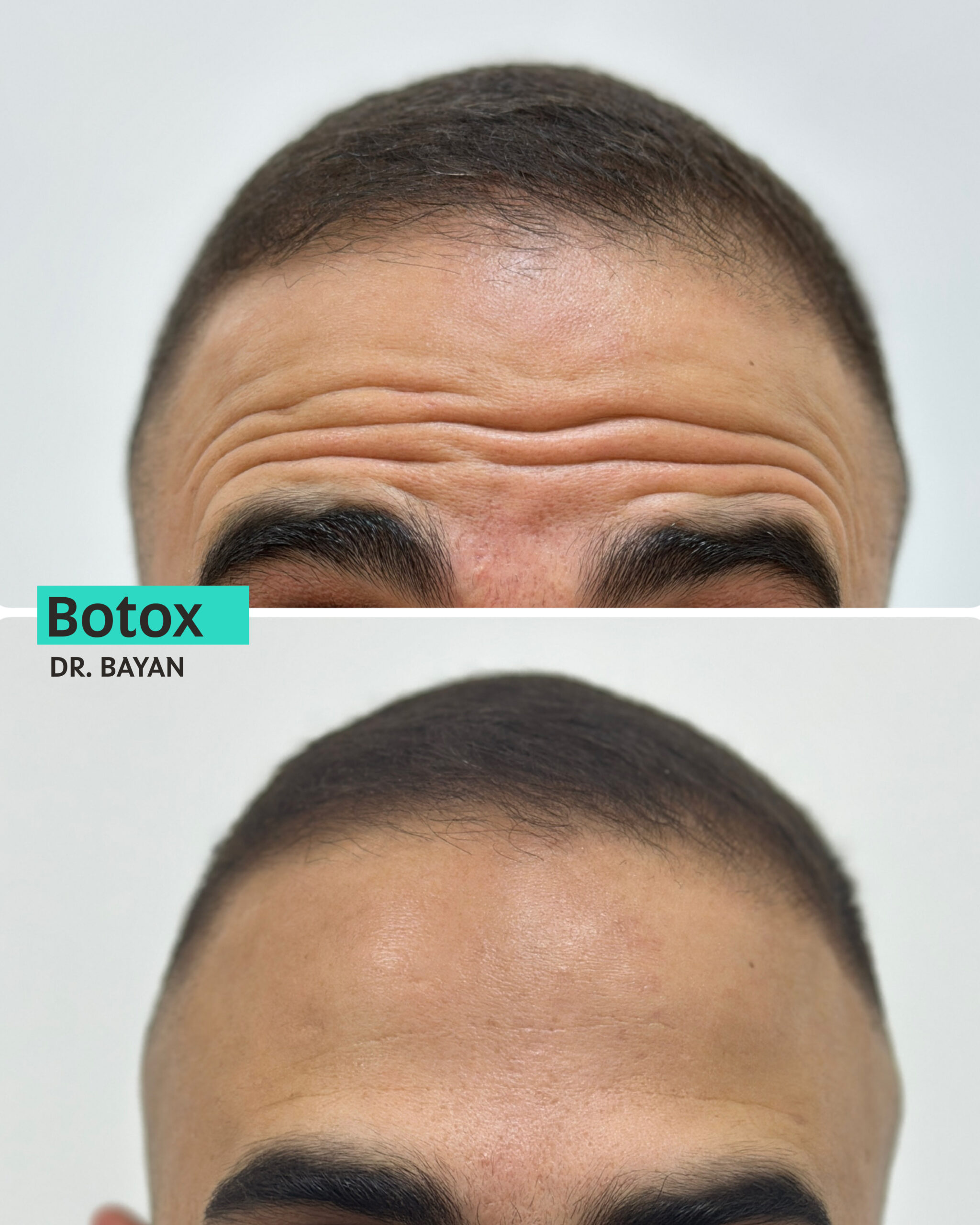 Botox Dubai