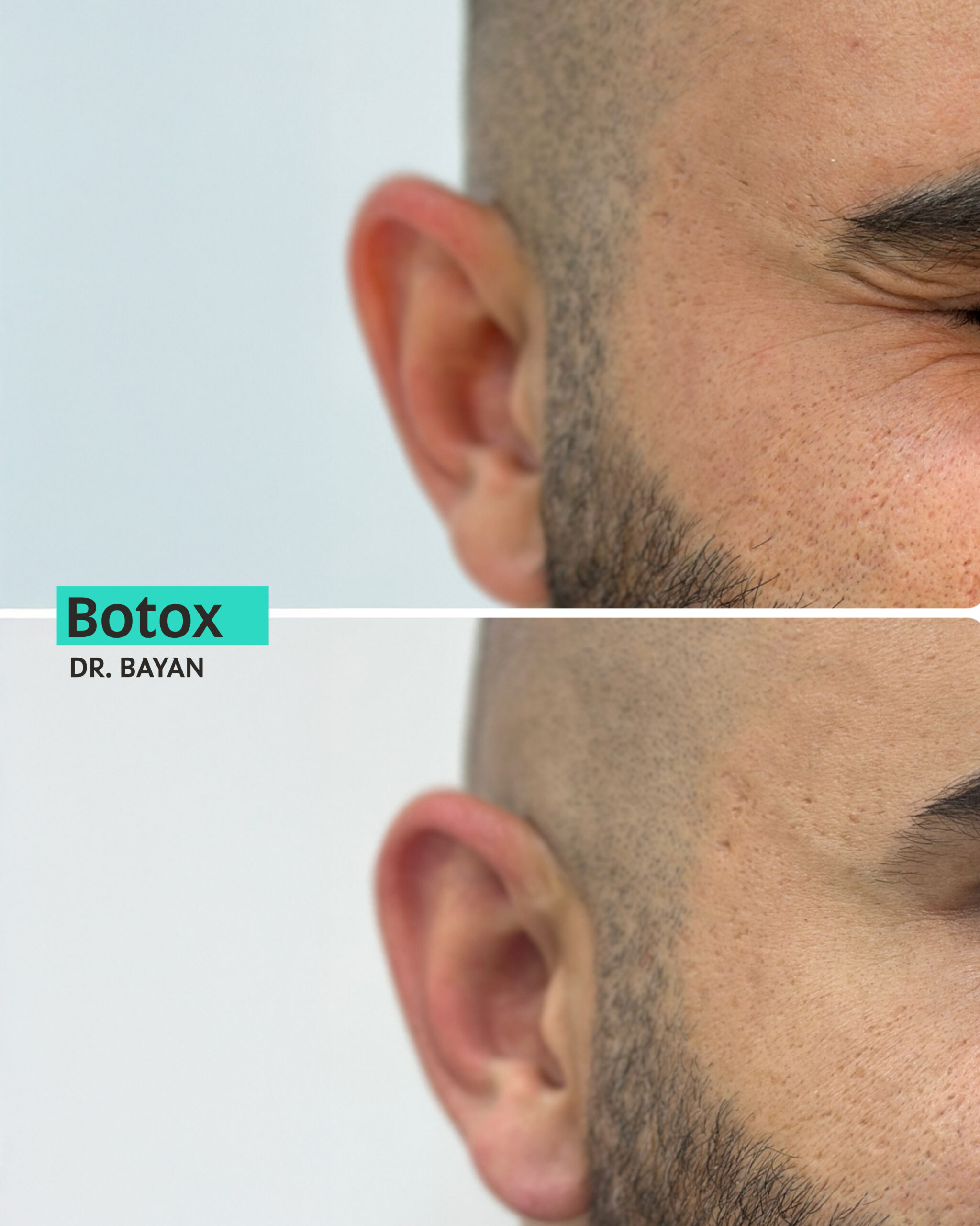 Botox Dubai
