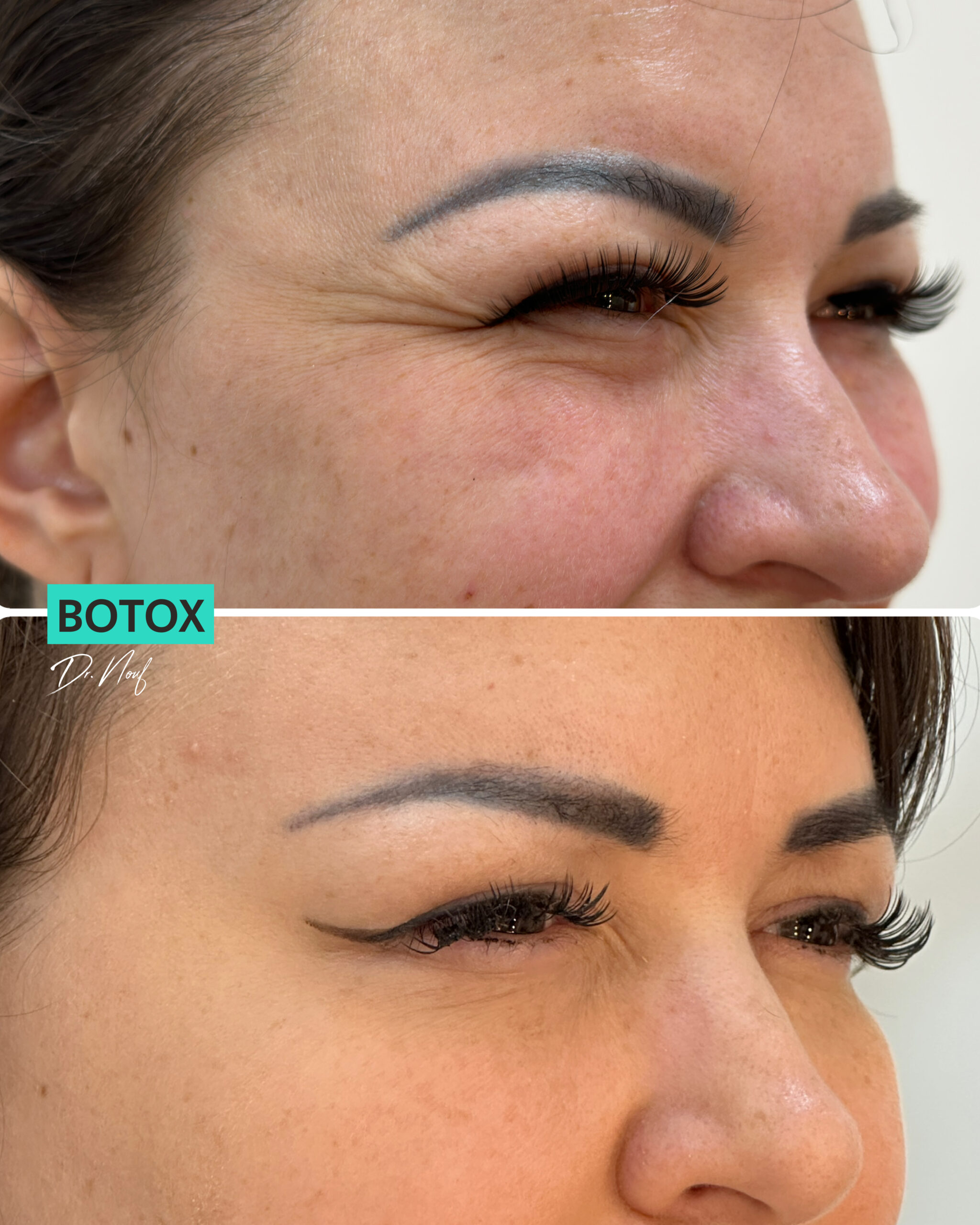 Botox Dubai