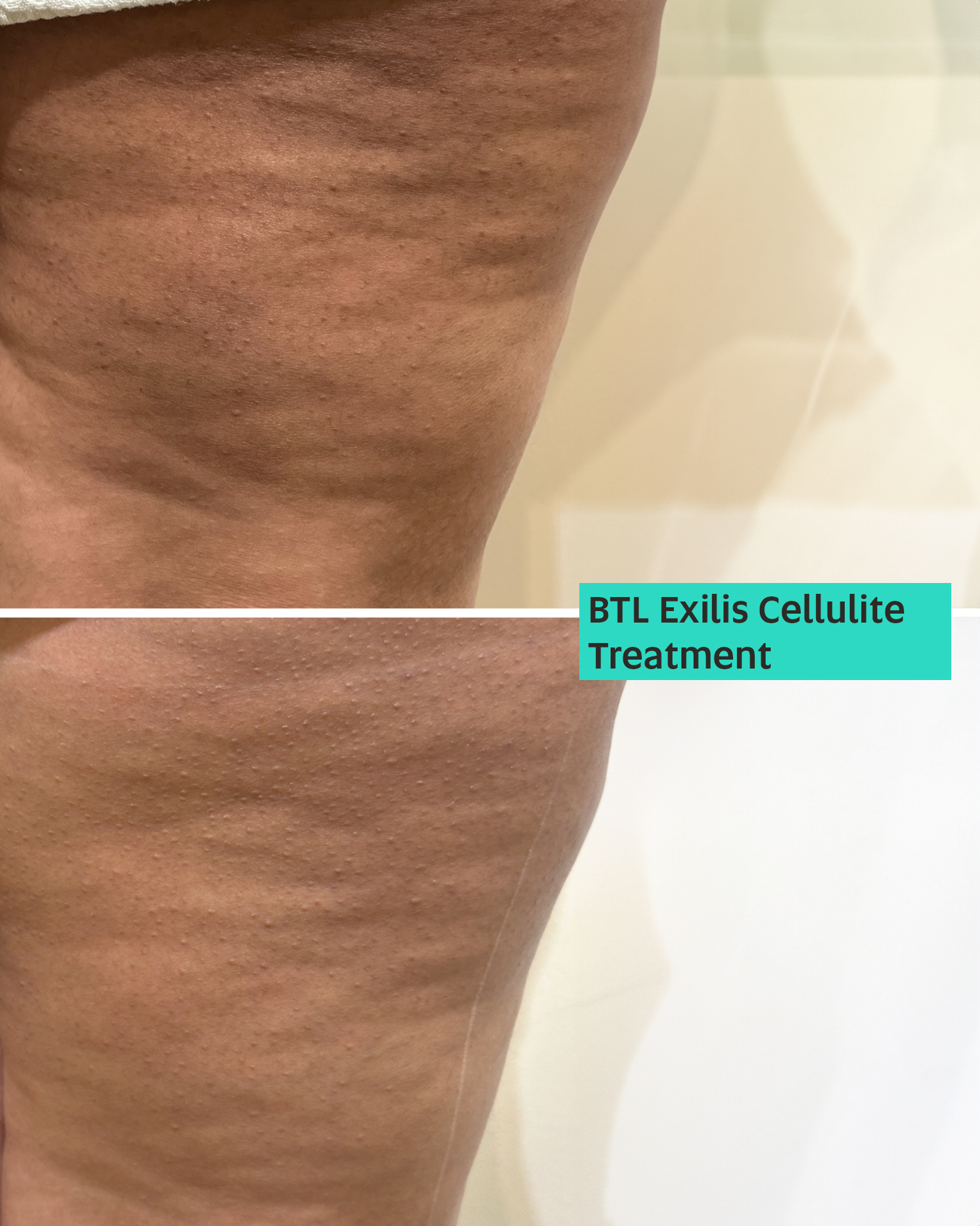 BTL Exilis
