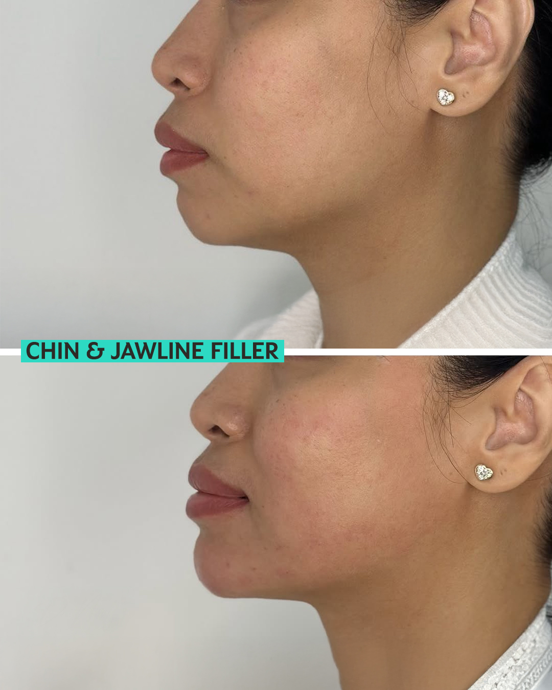 Jawline Filler