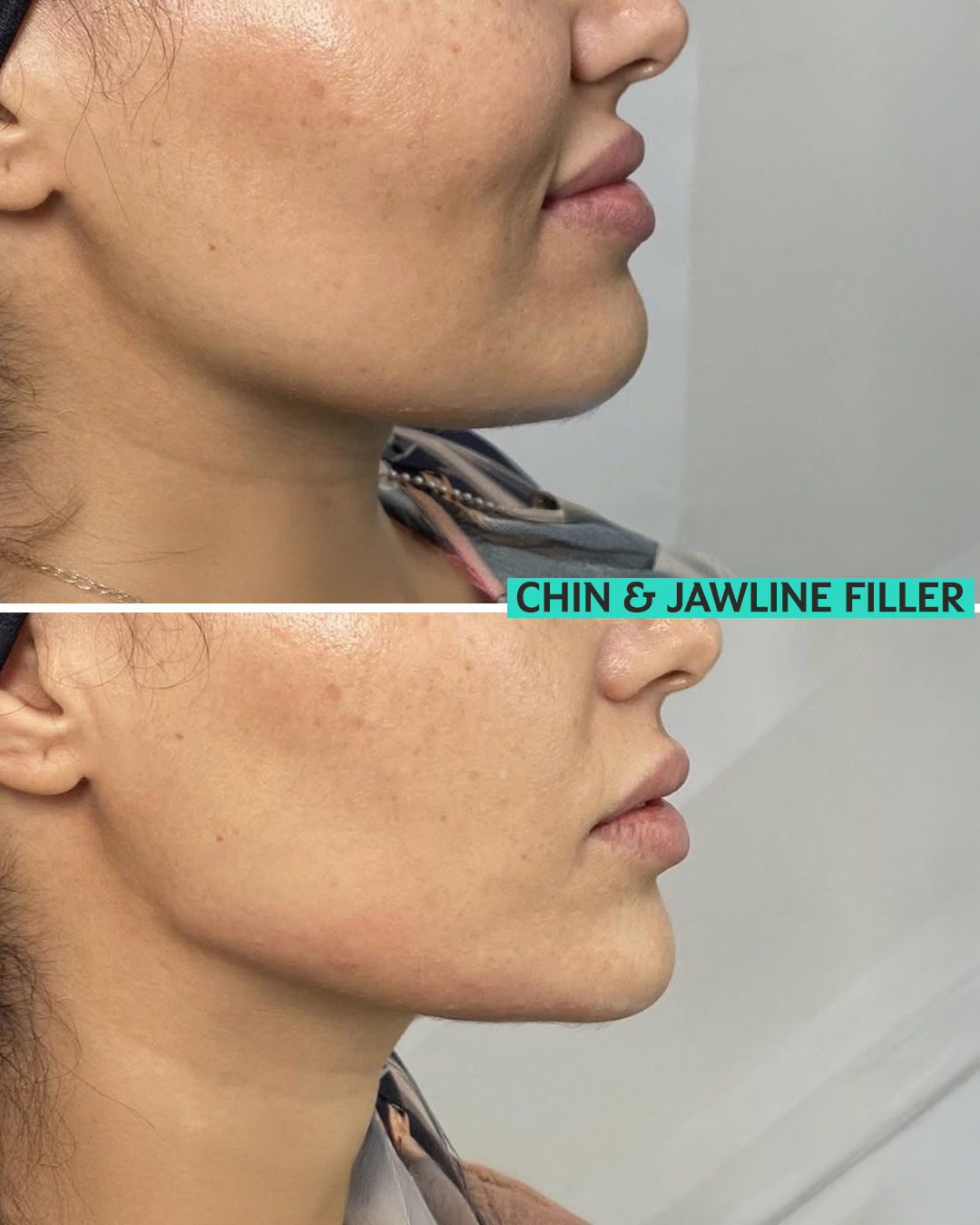 Jawline Filler
