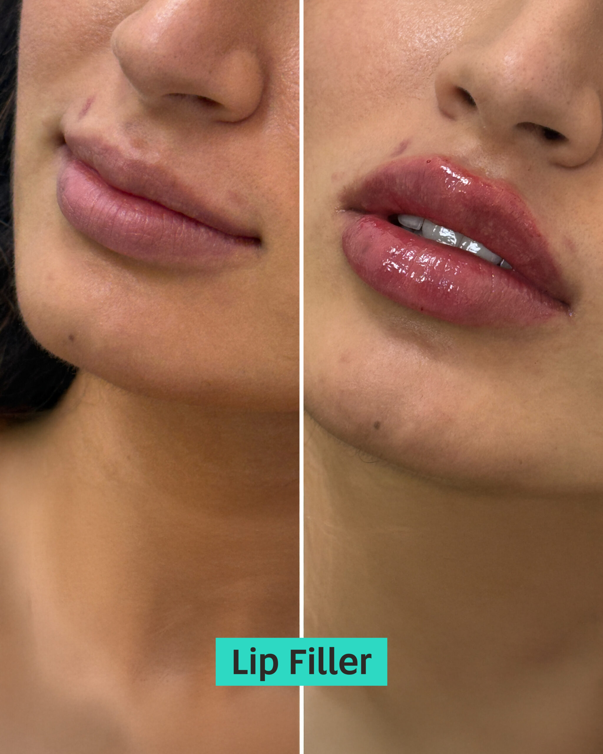 lip fillers dubai